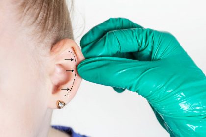 The hand of a plastic surgeon doctor holds the girl’s ear on which markers are marked for a surgical operation. Otoplasty in children. Copy space for text, close-up